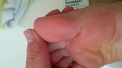 after-crystal-callus-remover