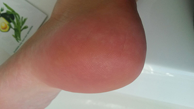 after-glass-callus-remover
