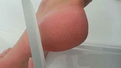 before-crystal-callus-remover