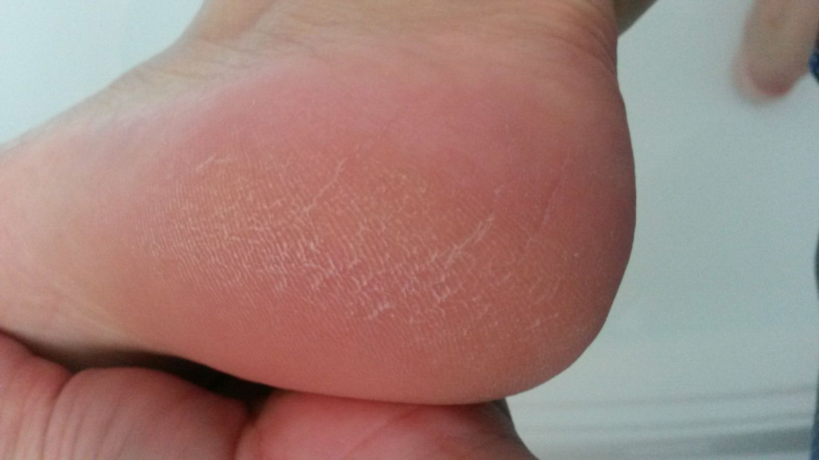 before-glass-callus-remover